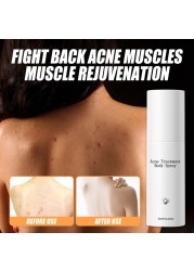 Acne Body Spray 100ml Body Chest Butt Back Acne External Use Multiple Daily Uses For All Skin Types Acne Treatment