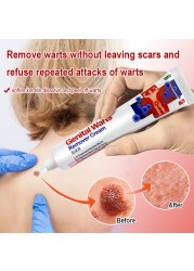 1pc Wart Remover Cream Skin Tag Mole And Papilloma Remover Treatment Private Parts Genital Wart Antibacterial Ointment G006