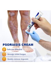 2pcs Psoriasis Cream Dermatitis Eczema Ointment Treatment Scaly Plaques Psoriasis Tina Pedis Relieve Itch Skin Care Cream A256