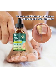 Nail Fungus Treatment Feet Care Nail Essence Repair Foot Toe Nail Fungus Removal Gel Anti Infection Paronychia Onychomycosis