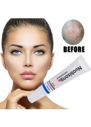 Nuobisong Face Skin Care Treatment Facial Pimples Scar Stretch Marks Removal Acne Treatment Whitening Moisturizing Cream