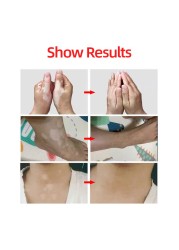 Chinese Medical Vitiligo Antibacterial Hand Spray White Spot Repair Liquid Foot Disease Leukoplakia Promote Melanin