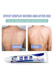 2pcs Psoriasis Cream Dermatitis Eczema Ointment Treatment Scaly Plaques Psoriasis Tina Pedis Relieve Itch Skin Care Cream A256