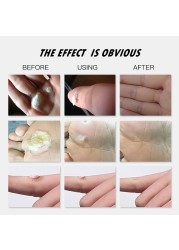 Medical foot care remove corns pads warts thorn treatment cream calluses remove callusitis detox professional foot cream