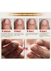 Fungal Nail Treatment Serum Onychomycosis Paronychia Anti-Fungal Nail Infection Herbal Toe Fungus Foot Repair Essence Care 50ml